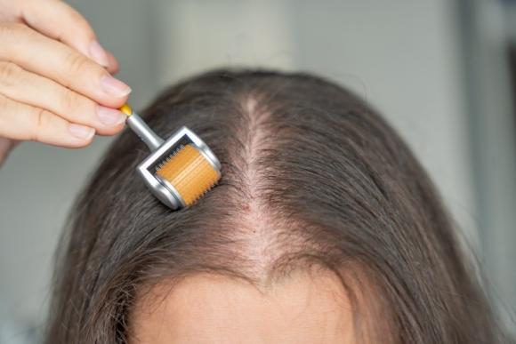 microneedling capillaire microneedling capillaire